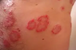 AZS przyczyny: co naprawdę wywołuje atopowe zapalenie skóry?