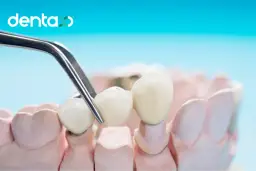 Mostek protetyczny: co to jest, rodzaje, koszt i czy warto?