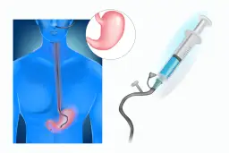 Czy rozmiar ma znaczenie sonda? Jak wybór wpływa na komfort pacjenta