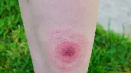 Neuroborelioza objawy psychiczne: jak rozpoznać i leczyć skutki