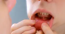 Zapalenie jamy ustnej: objawy, które musisz znać. Kiedy do lekarza?