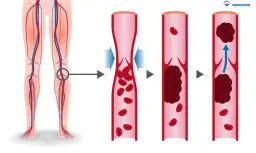 Zakrzepica żył: Leki, leczenie i dlaczego tylko na receptę?