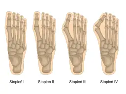 Haluksy: Jak rozpoznać paluch koślawy w domu?