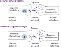 Die entscheidenden Schritte der Parkinson Diagnostik verstehen