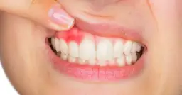 Skuteczne metody leczenia krost w jamie ustnej i ich przyczyny