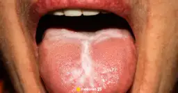 Alergia jamy ustnej: swędzenie po jedzeniu? Poznaj objawy i leczenie