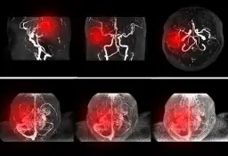 Ból tętnicy szyjnej objawy: co może oznaczać Twój ból?