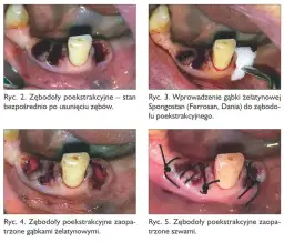 Krwawienie po wyrwaniu zęba: ile trwa i kiedy szukać pomocy?