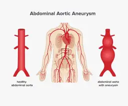 Aneurysma Symptome Bauch: Warnsignale, die Sie nicht ignorieren sollten