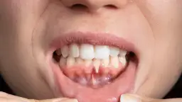 Przeszczep dziąsła: Czy warto? Pełna analiza, koszty i efekty