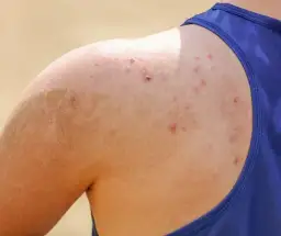Skuteczne sposoby na pryszcze na plecach - uniknij bólu i blizn