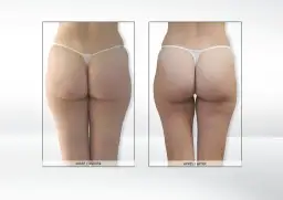 Endermologia: czy warto? Opinie z forum, koszty i efekty (70 znaków)