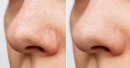 Jak usunąć pryszcza z nosa? Skuteczne metody i porady na co dzień