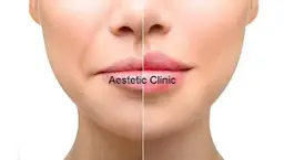 Laserowe powiększanie ust: Efekt na 6-12 miesięcy? Jak go przedłużyć?