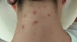 Pryszcze na szyi: przyczyny, leczenie i jak się ich pozbyć