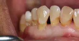 Jak skutecznie zregenerować dziąsła? Domowe i profesjonalne metody