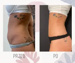 Liposukcja brzucha: Ile kosztuje? Pełny cennik i ukryte wydatki