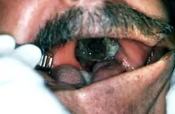 Jak rozpoznać czerniaka w ustach? Objawy i wygląd zmiany