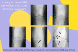 Choroba zwyrodnieniowa: Czy Cartexan to rozwiązanie dla Twoich stawów?