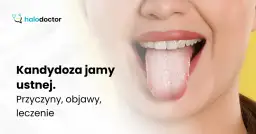 Kandydoza jamy ustnej: objawy, przyczyny i kiedy iść do lekarza
