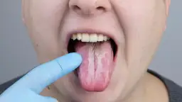 Biały nalot w ustach? Rozpoznaj grzybicę i znajdź rozwiązanie!