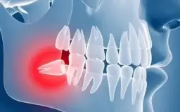 Dlaczego ósemki to zęby mądrości i co to oznacza dla zdrowia?