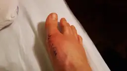 Jak zrobić opatrunek po operacji haluksa, aby uniknąć komplikacji