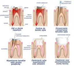 Przepełnienie kanału zęba objawy: jak rozpoznać i uniknąć bólu