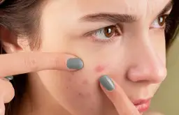 Czy powinno się wyciskać pryszcze? Poznaj ryzyko i skutki tej praktyki