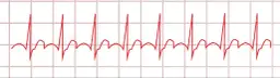 Myokarditis Diagnostik EKG: EKG-Befunde verstehen und richtig deuten