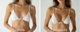 Ácido hialurónico pecho antes y después: resultados sorprendentes y reales