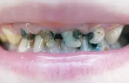 Jak wygląda próchnica zęba? Rozpoznaj ją od plamy do dziury!