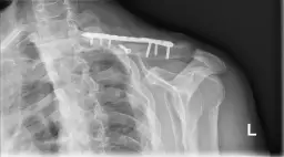 Ile trwa rehabilitacja po złamaniu obojczyka i jak ją przyspieszyć?