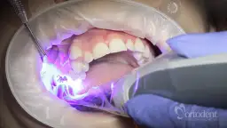 Aparat na zęby: Bezbolesne zakładanie? Przewodnik krok po kroku