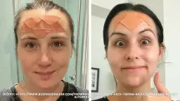 Lwia zmarszczka: Botoks czy kwas hialuronowy? Wybierz mądrze!