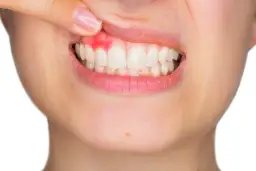 Zapalenie dziąseł u dziecka: Ile trwa i kiedy do dentysty?
