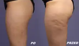 Skuteczne sposoby na usunięcie cellulitu z nóg i ujędrnienie skóry