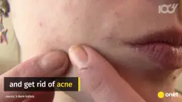 Maść ichtiolowa na pryszcze: Ile trzymać? Noc to klucz!