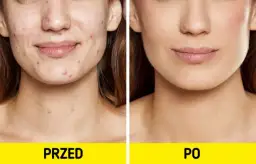 Jak pozbyć się pryszczy na twarzy - skuteczne metody i porady