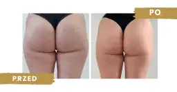 Endermologia czy warto? Szczera ocena efektów, kosztów i ryzyk.