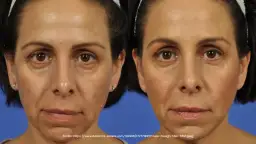 Dolina łez czy kurze łapki? Kwas hialuronowy vs. botoks pod oczy