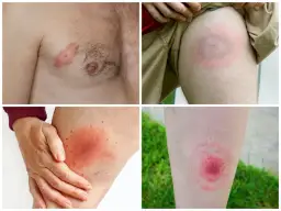 Jakie są objawy boreliozy - rozpoznaj groźną chorobę z Lyme wcześnie