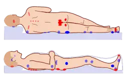 Skuteczne metody na odleżyny u starszej osoby - jak zapobiegać i leczyć