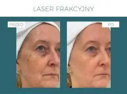 Laser frakcyjny nieablacyjny: odmłodź skórę bez długiej rekonwalescencji.
