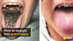 Bolesne afty w jamie ustnej? Odkryj przyczyny i szybką ulgę!