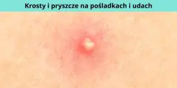 Pryszcze na pośladkach: poznaj przyczyny i skuteczne sposoby na ich leczenie