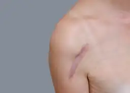 Widok z bliska na bliznę na ramieniu osoby.