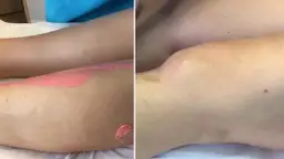 Depilacja woskiem co ile? Odkryj idealne odstępy dla skóry