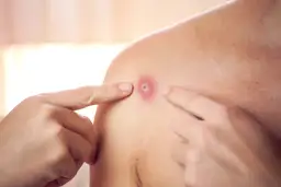 Palce wskazują na zaczerwienioną zmianę skórną z żółtym czubkiem. Jak odróżnić czyraka od pryszcza?