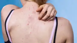 Widok z tyłu na plecy kobiety z pryszczami i ręką drapiącą skórę.